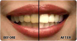 Teeth Whitening Images and video