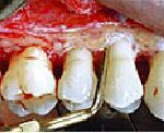 treatment of pyorrhea flap surgery image by bharat agravat dentist india